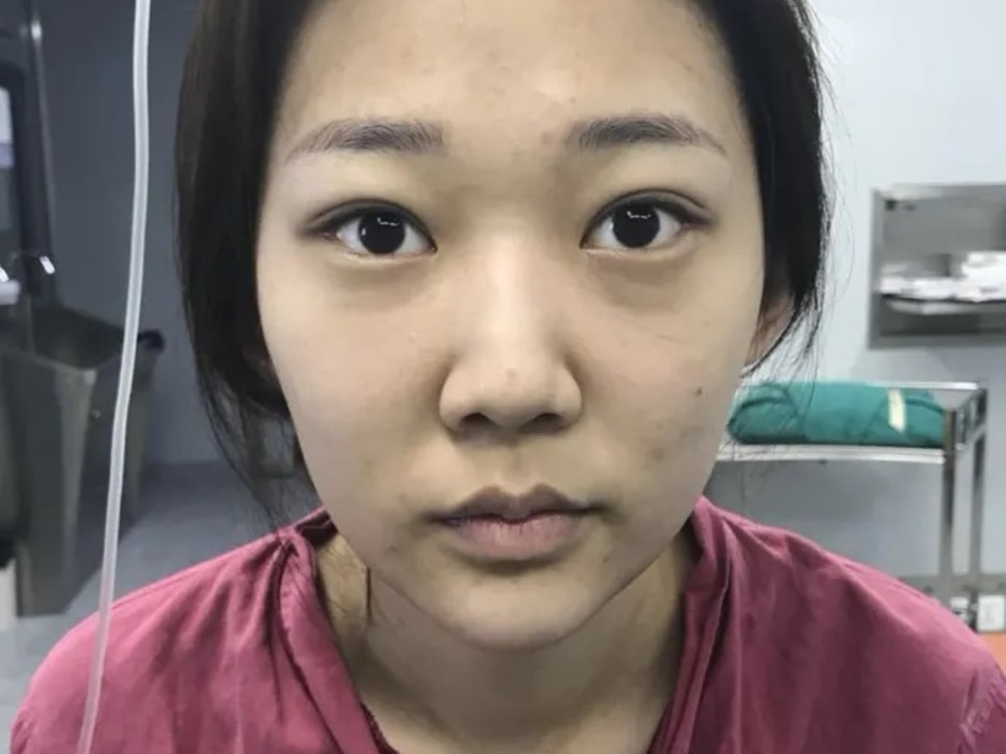 92术前的自己矮鼻梁,宽鼻翼,塌鼻头,面部整体看起来_圈子-新氧美容