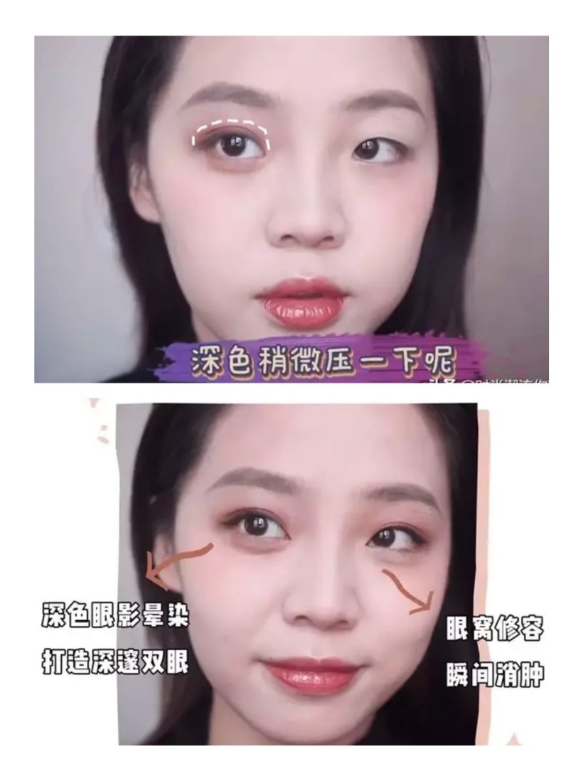 7815肿眼泡是亚洲人非常常见的眼睛类型,一般眼睑肿胀_圈子-新氧