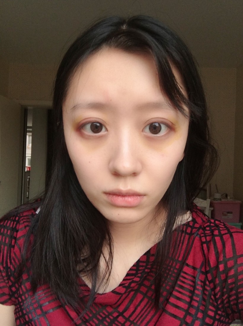 【开外眼角术后9天】忽略我这个低像素的照片哈,自我_圈子-新氧美容