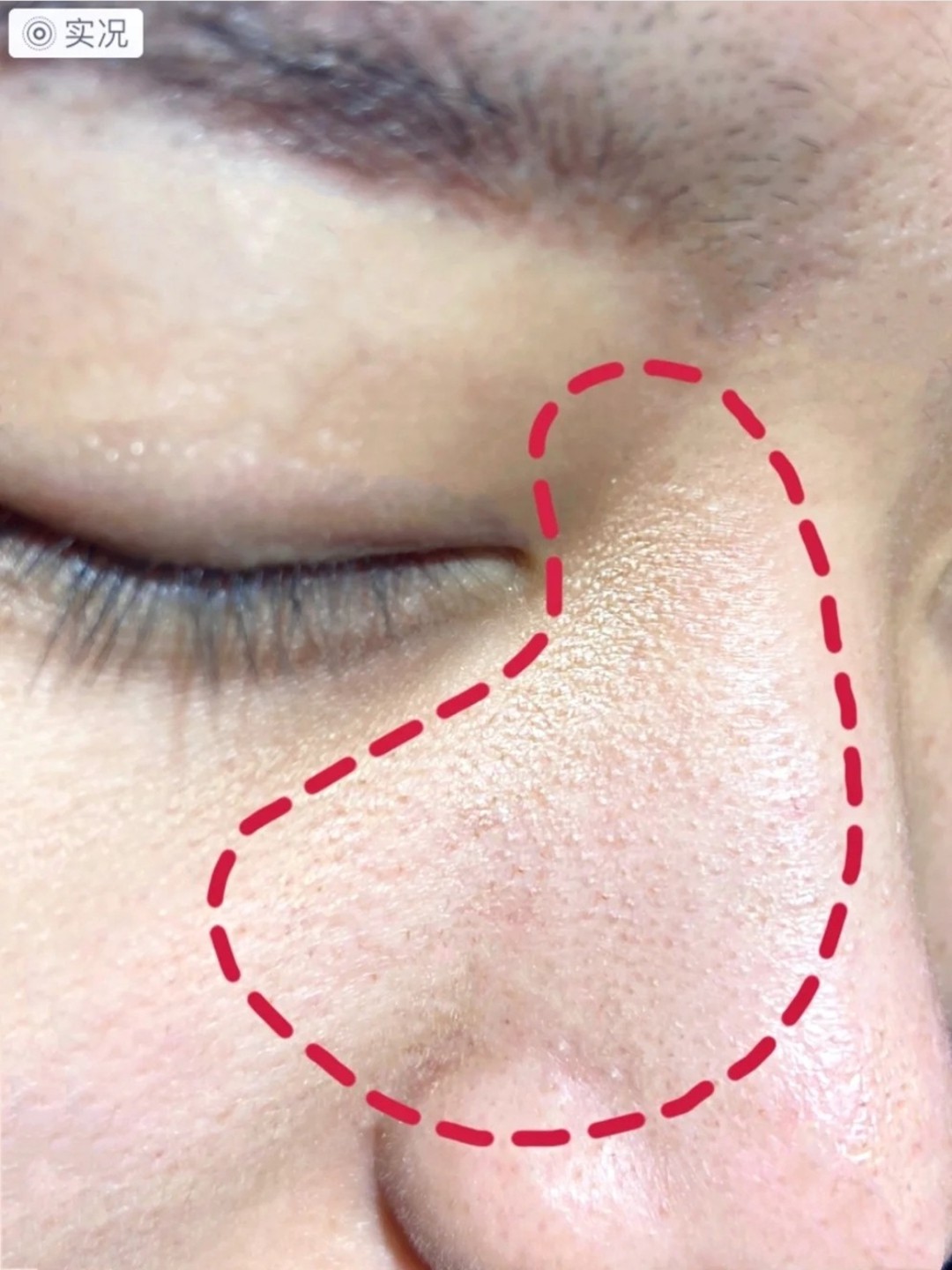 眼下鸡皮肤解决方法(怎么保护鸡眼旁边的皮肤) 眼下鸡皮肤解决方法(怎么保护鸡眼旁边的皮肤)