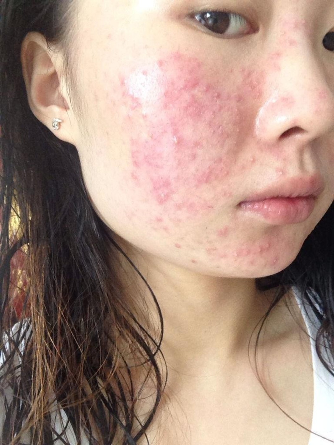 痘痘是毛囊皮脂腺的慢性炎症,表现为红色的炎症性的丘疹,脓疱,结节