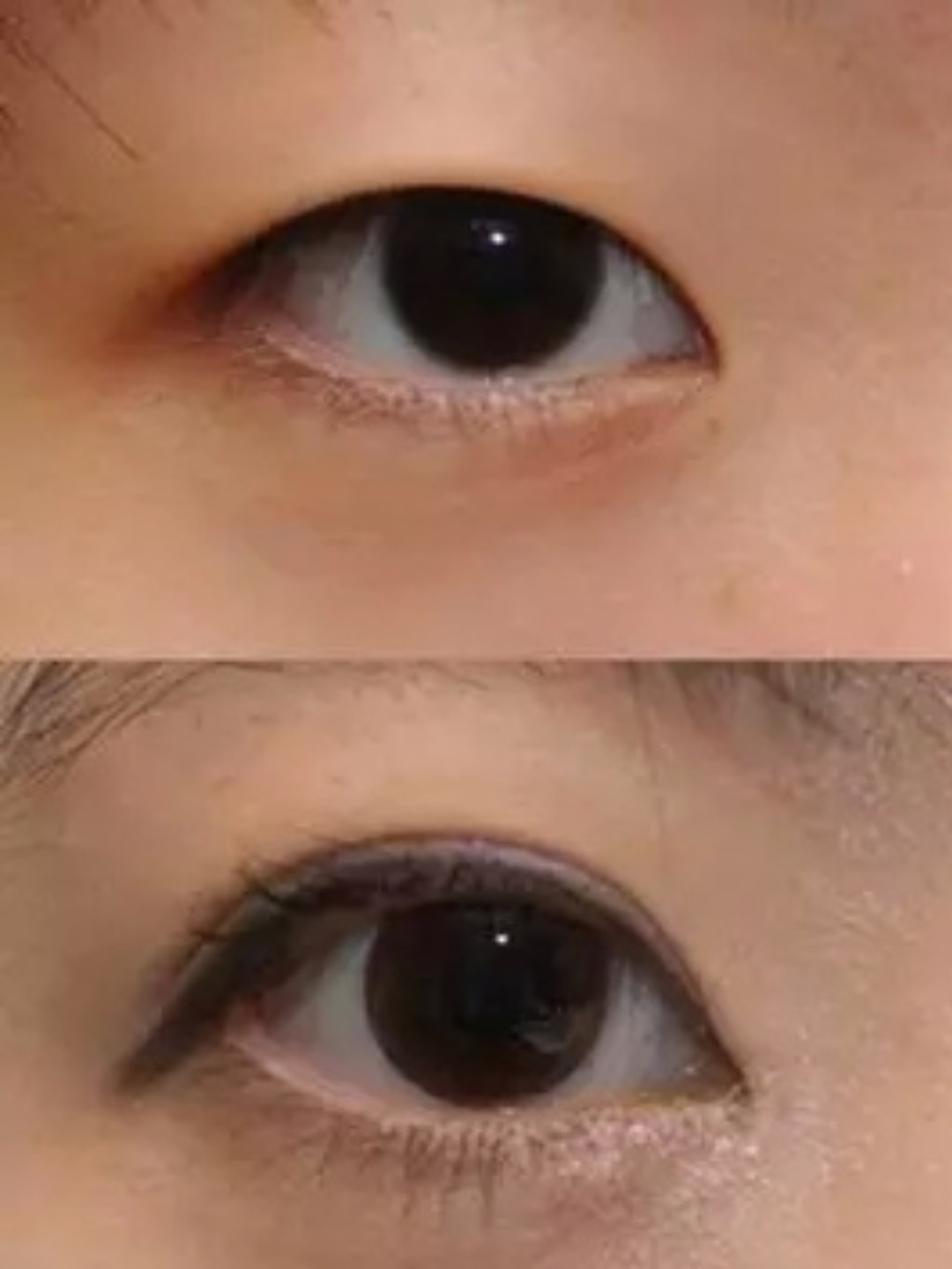 术前是一双执刀手术医生都会喜欢的,无内眦赘皮,没有肿眼泡,不存在提