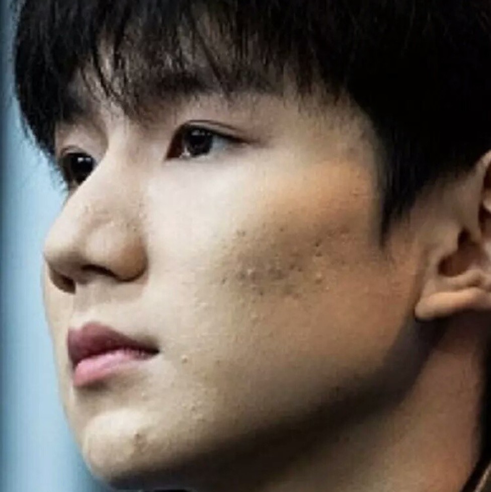 皮肤的松弛使这些毛孔和痘坑越来越明显,我们说的「麻子脸」就是这样