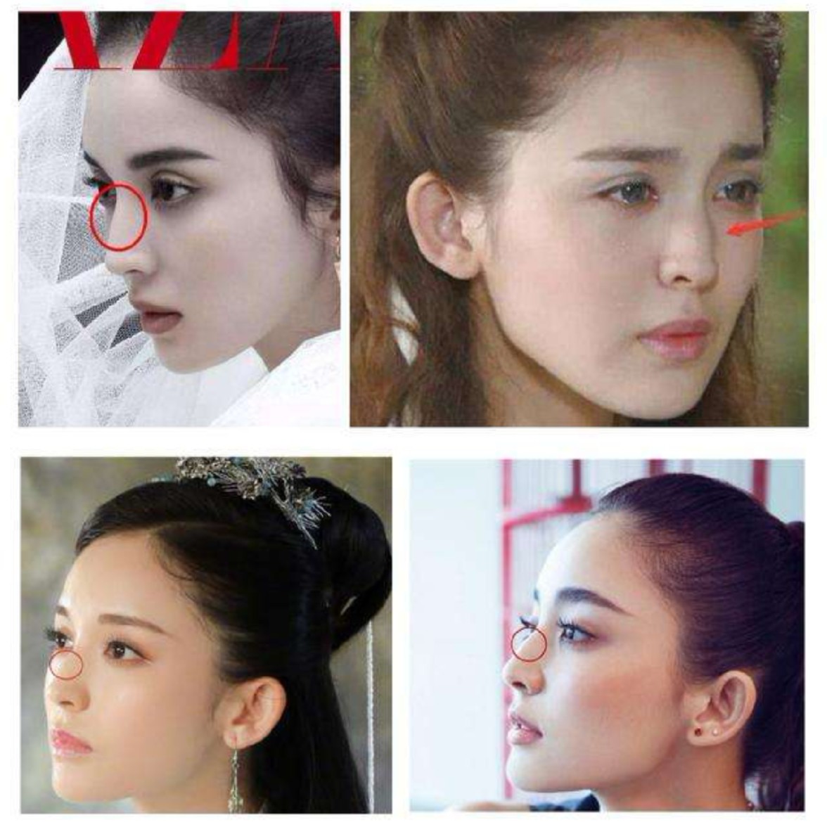 从原本的驼峰鼻变成了小翘鼻明星隆鼻