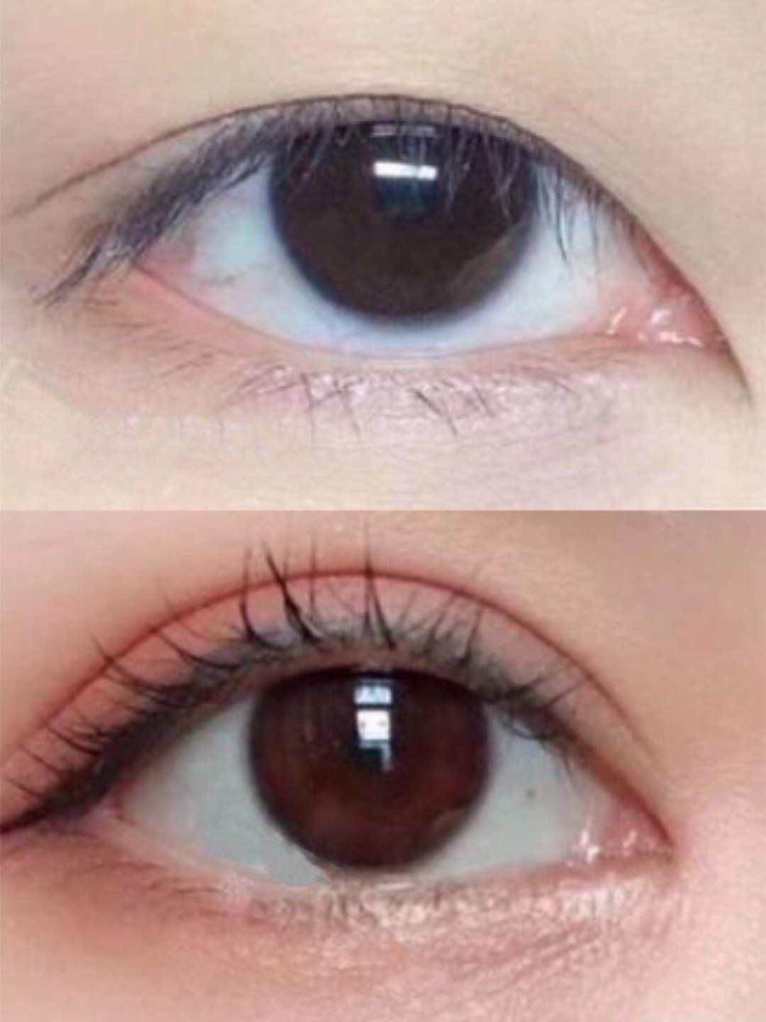 9595眼尾下至手术,其实就是改善"吊眼"的情况.