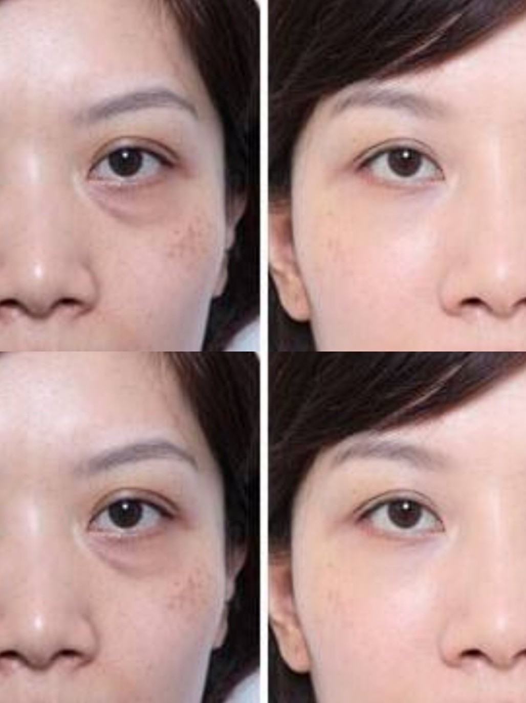 医美去泪沟,简单的很!