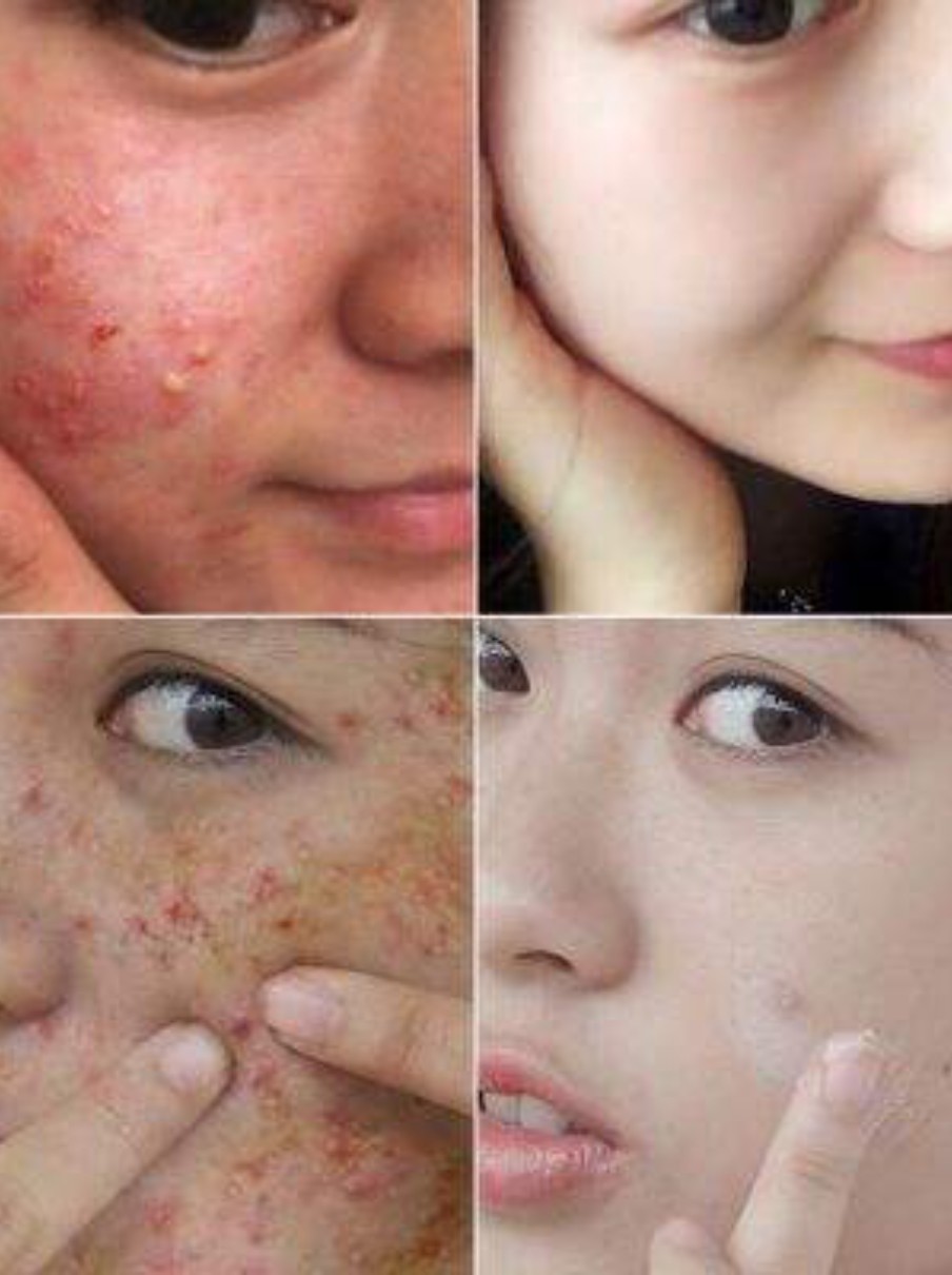 代表美女消灭痤疮,告别痘痘肌!