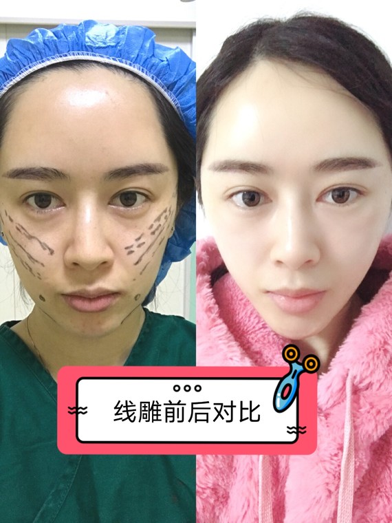 关于vsta干细胞美容跟线雕哪个好些的信息