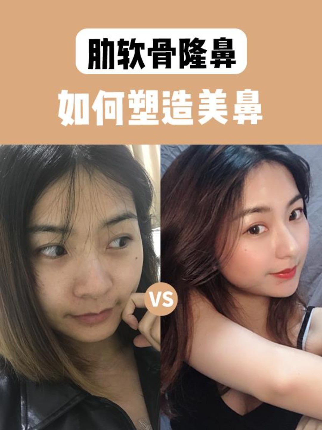 大鼻头难道只能通过鼻骨内推才能改善吗
