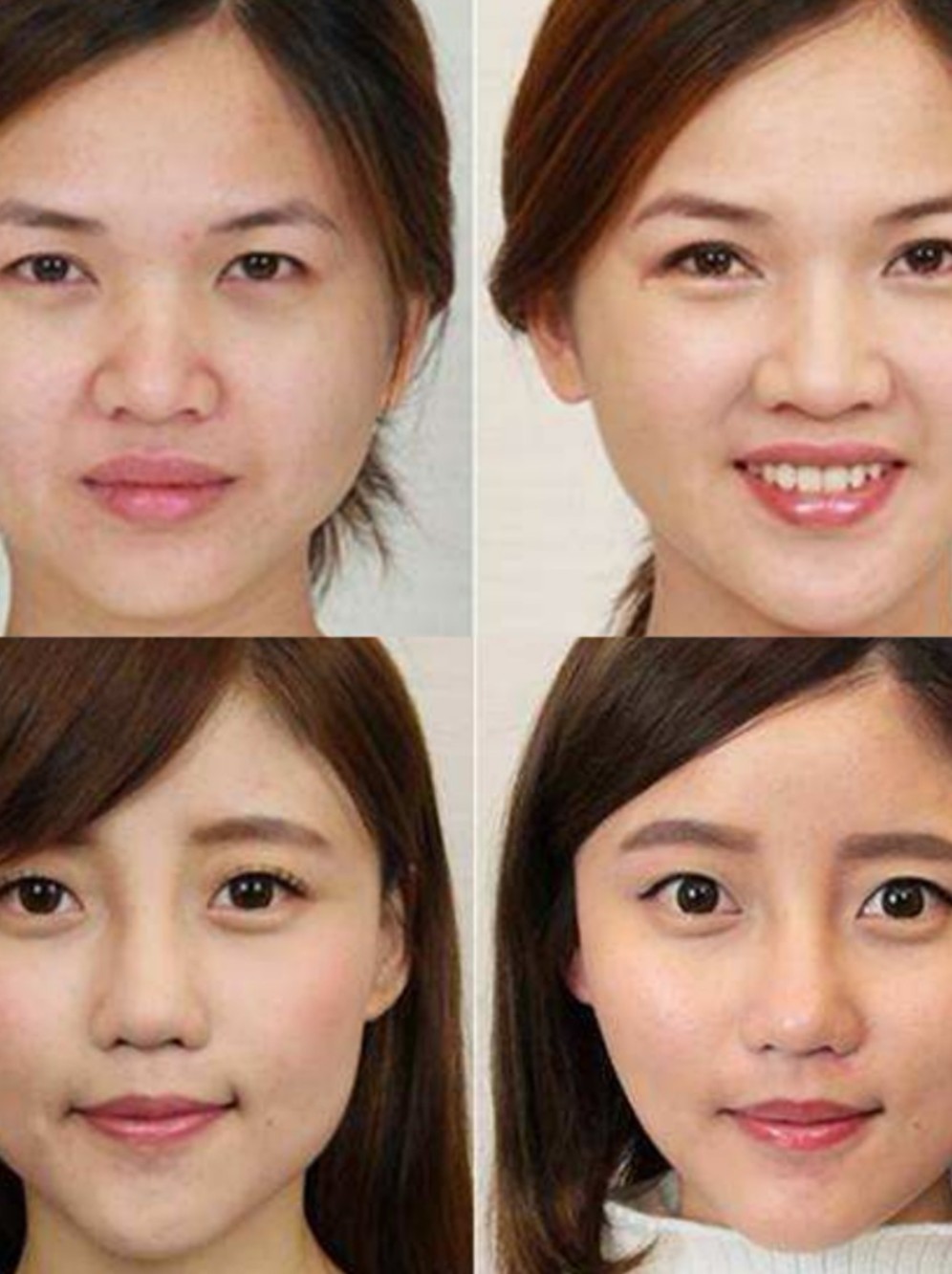 当今社会,不管是明星或普通人,利用瘦脸针来瘦脸求美,似乎都是一件很