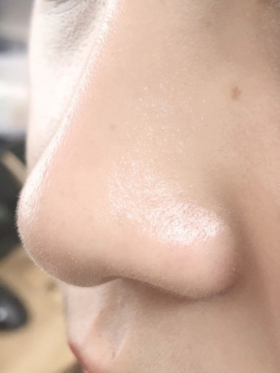 黑头粉刺心动牛奶鼻73拜拜草莓鼻94本来有点庆幸没有_圈子-新氧