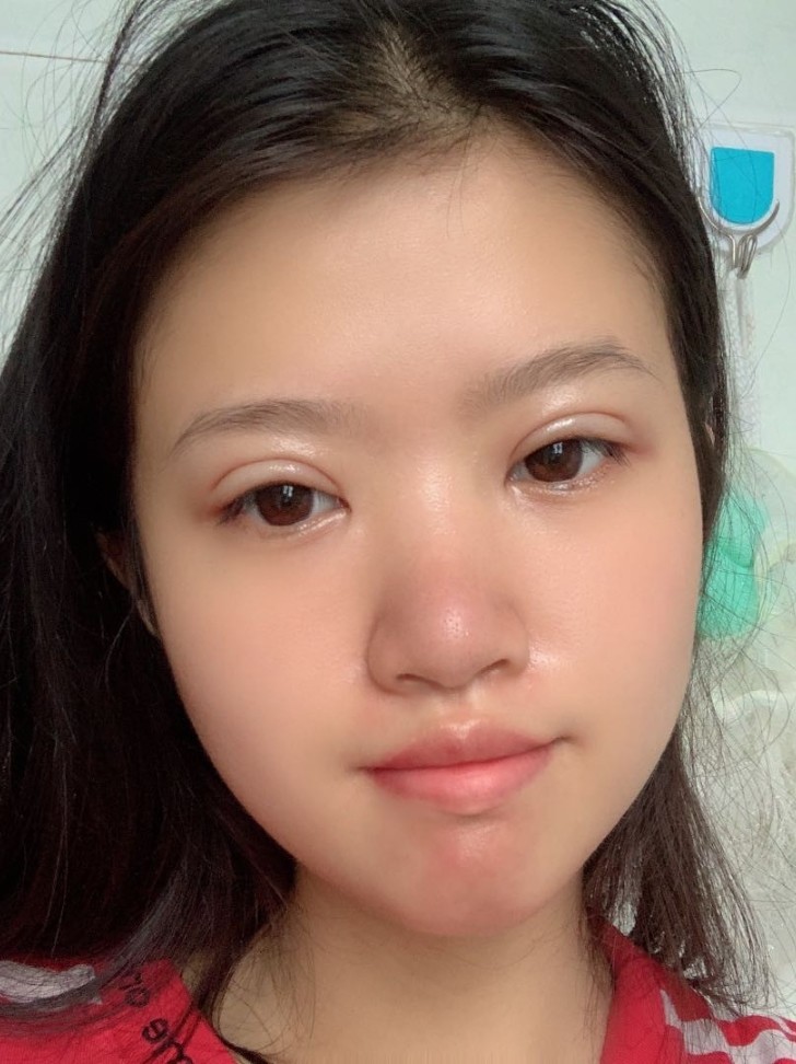 做了双眼皮肿胀是很正常的,我也是肿了一段时间的,可_圈子-新氧美容