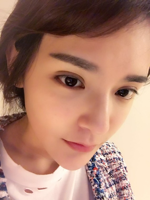 双眼皮形成多层眼皮_圈子-新氧美容整形