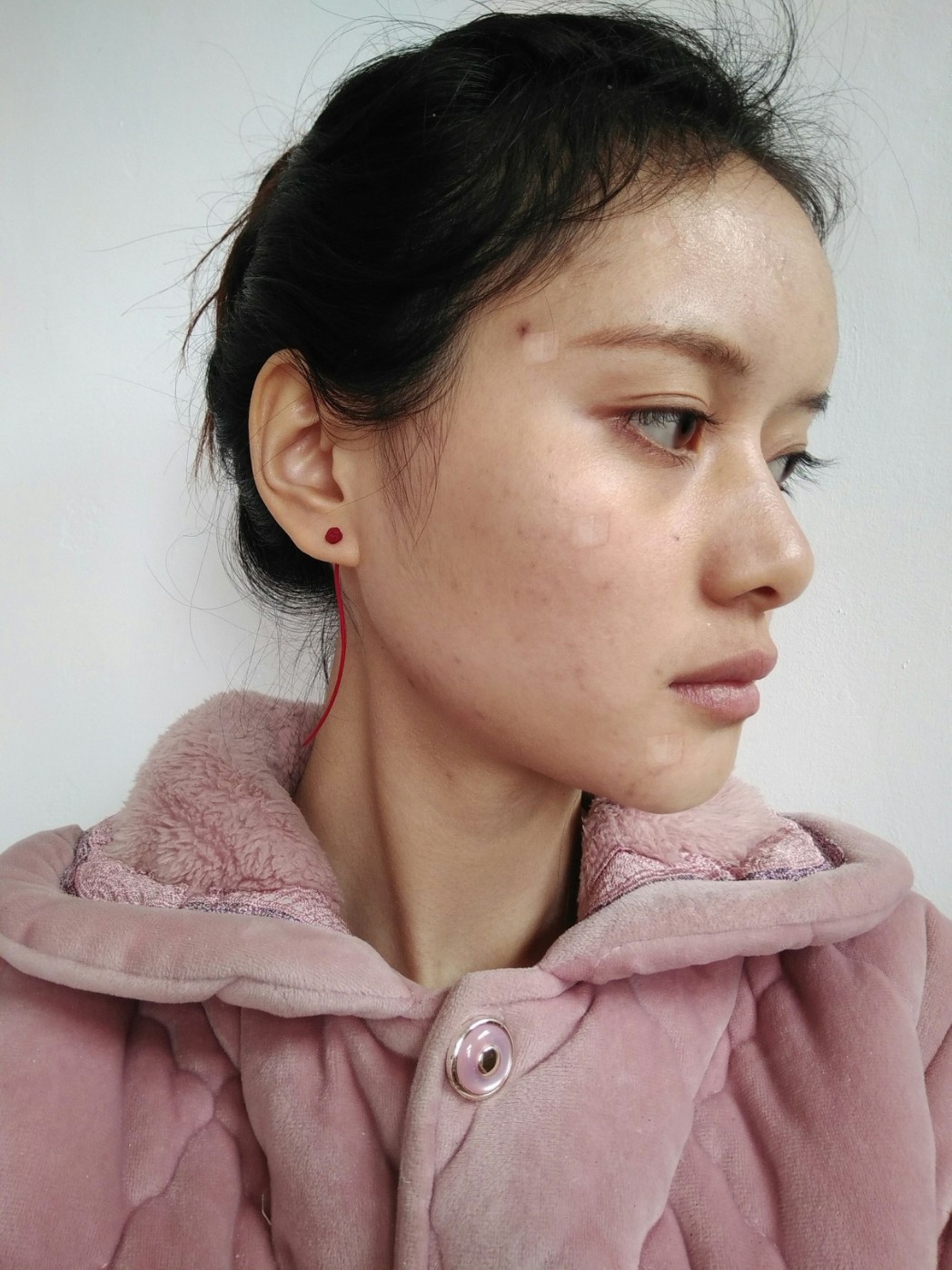 【自体脂肪全脸填充第3天】我家在内蒙呢,这次是专