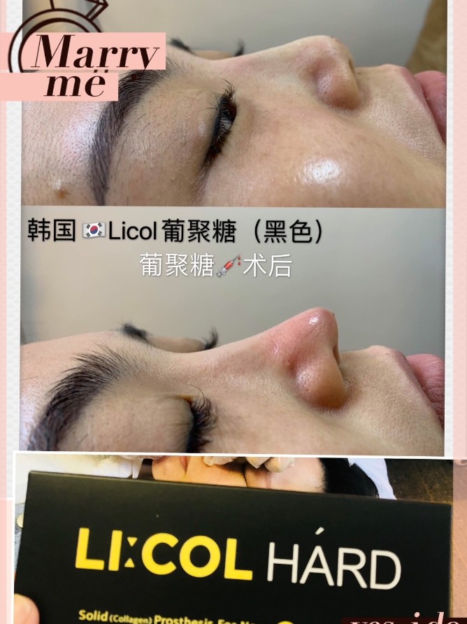 这样的鼻子你满意吗