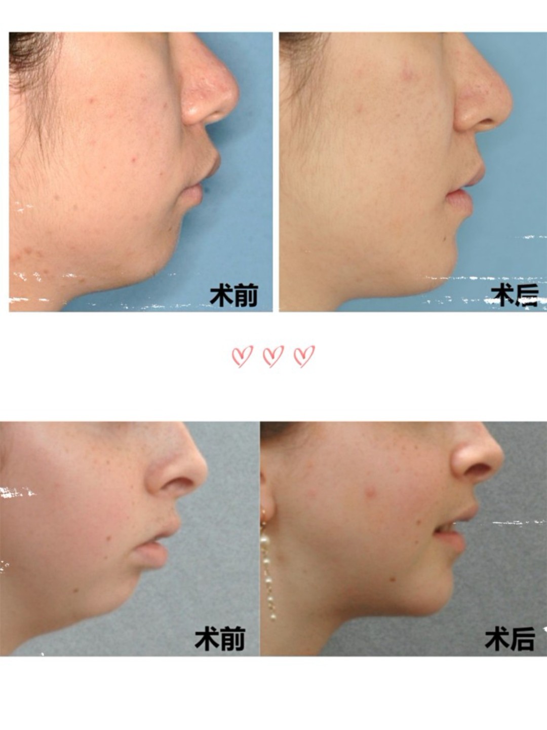 它可分为两类,单纯下巴后缩和下颌骨发育不足.