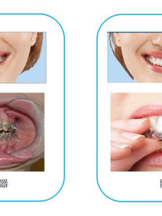 90隱形牙套和鋼絲牙套,那個比較好一些,有困擾的朋友_圈子-新氧美容