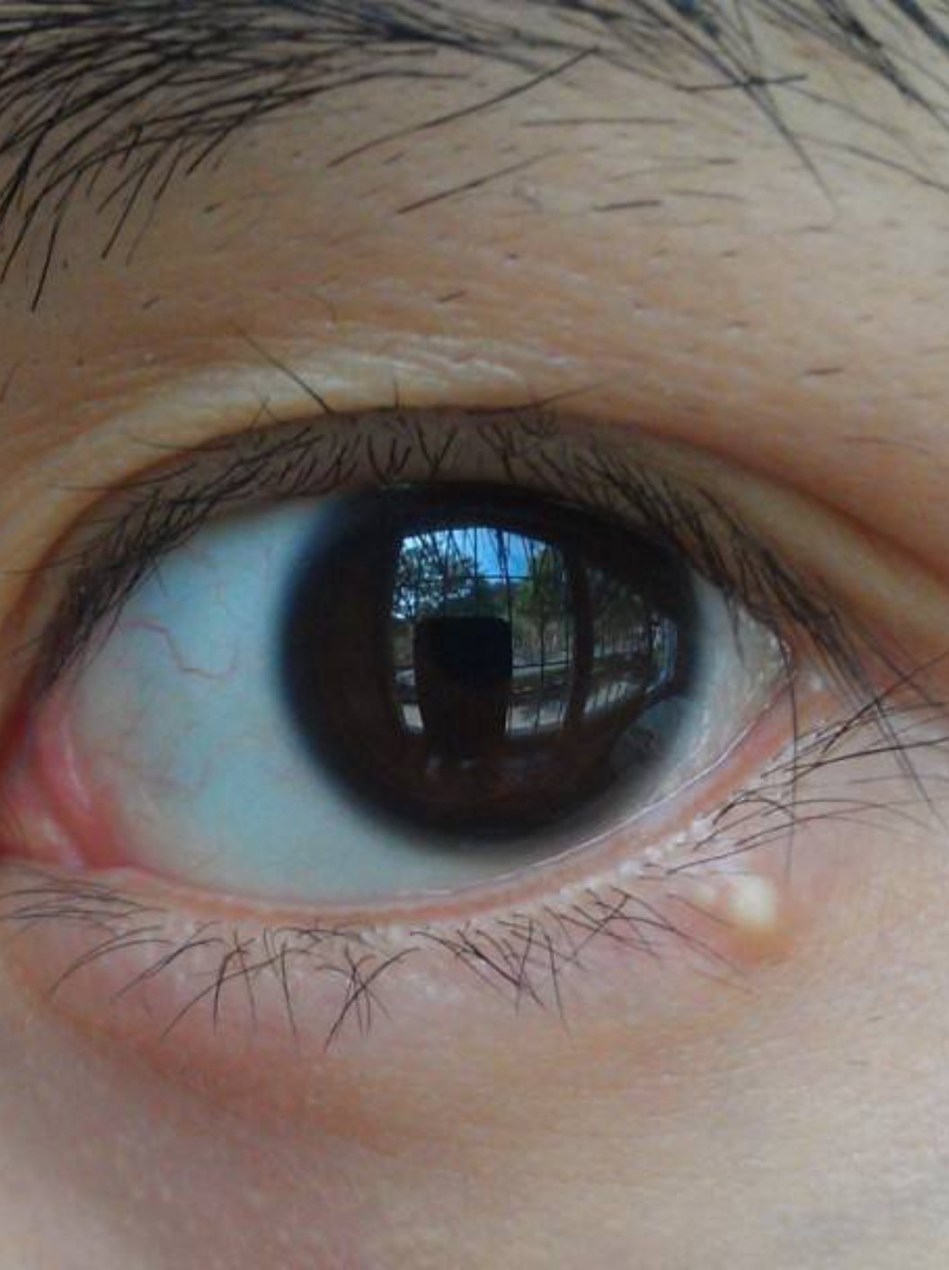 脂肪粒的形成主要是因为皮肤上有细小的伤口,在皮肤自_圈子-新氧美容