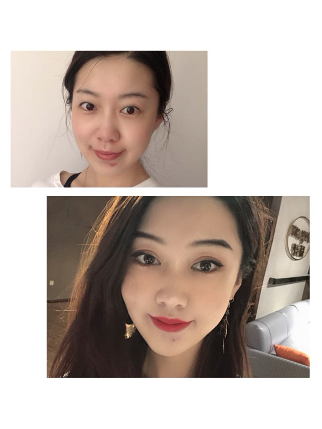 【雅美整形】双眼皮术后蹈65天