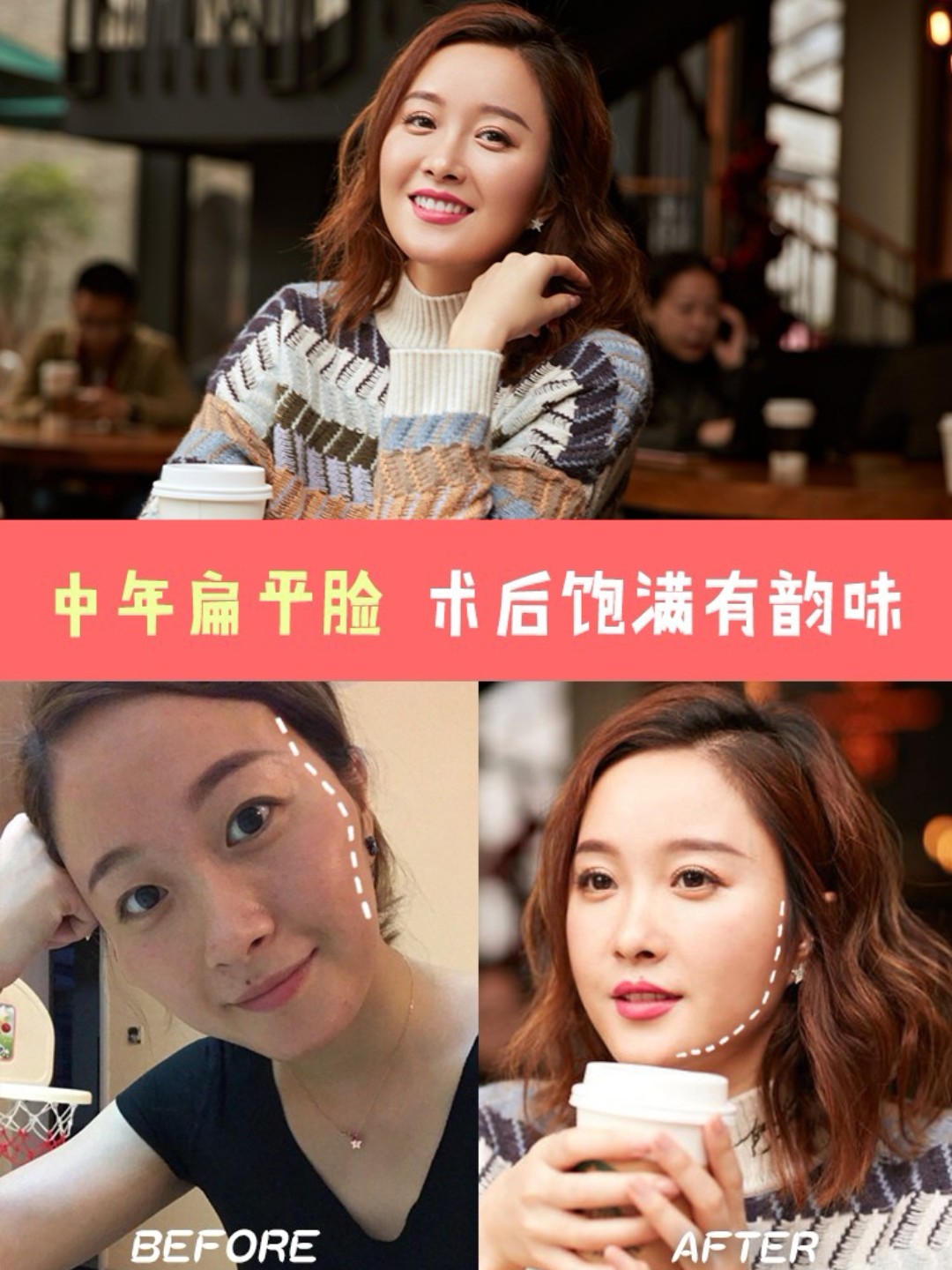 中年扁平脸 术后饱满有韵味