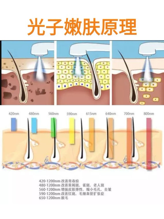 縮毛孔?祛痘印?試試光子嫩膚!】