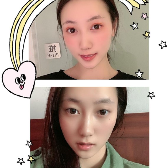 做双眼皮_圈子-新氧美容整形