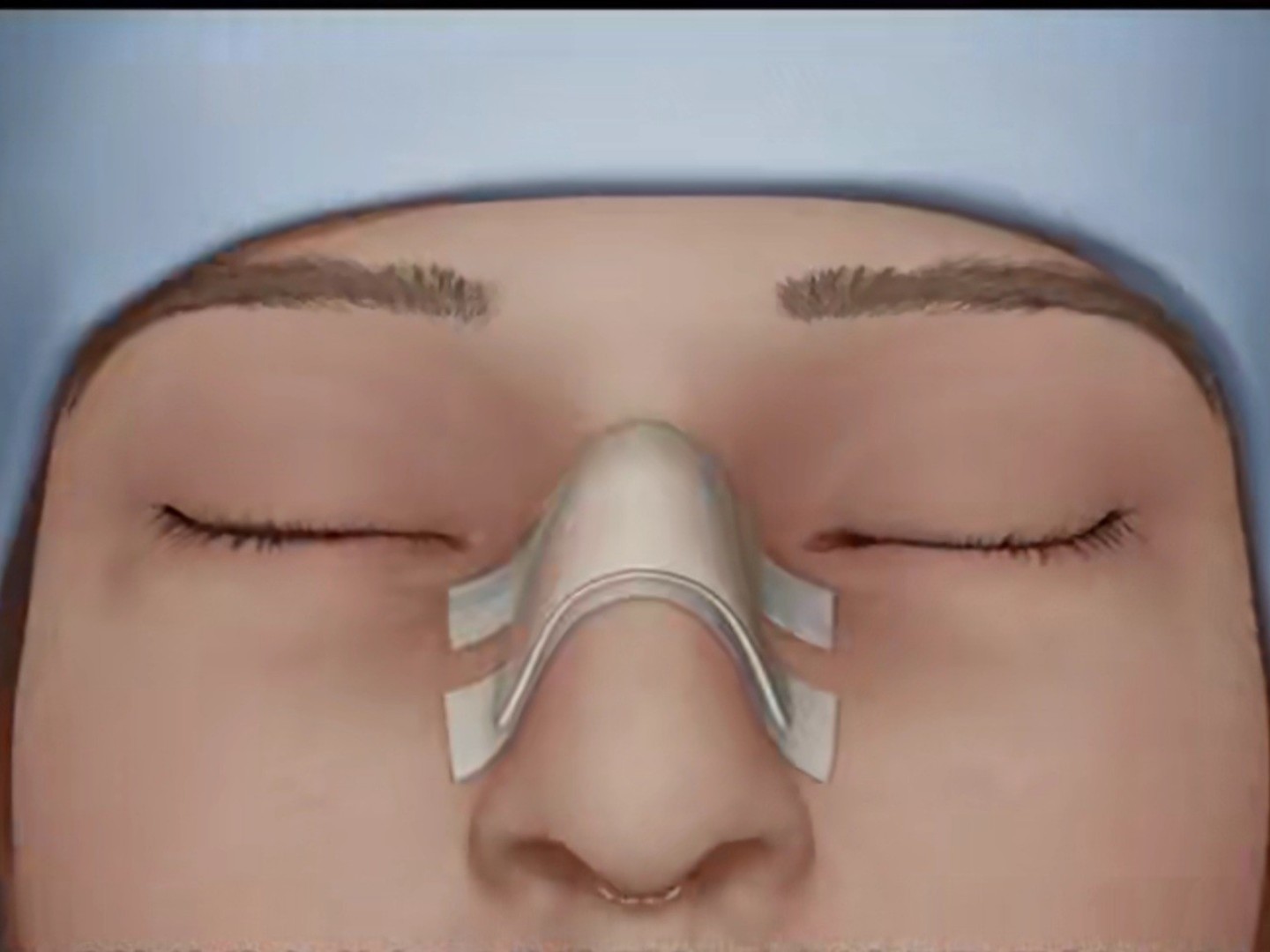 复杂的隆鼻手术里今个儿先从宽鼻变窄鼻说起让我们来细剖一下手术过程