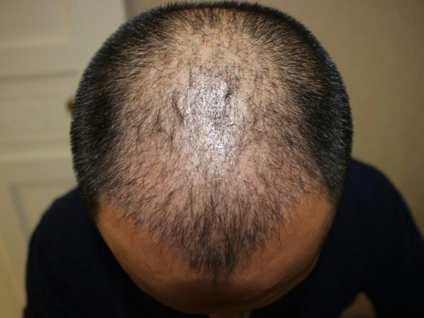 大麦微针植发术后1个月:种植区的头皮和周边的头皮颜_圈子-新氧美容
