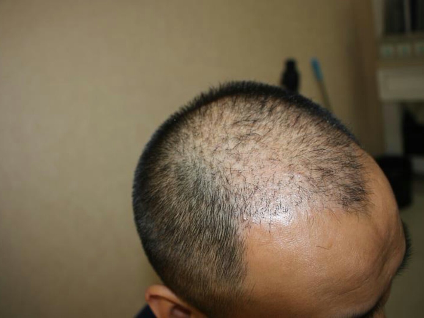 大麦微针植发术后1个月:种植区的头皮和周边的头皮颜_圈子-新氧美容