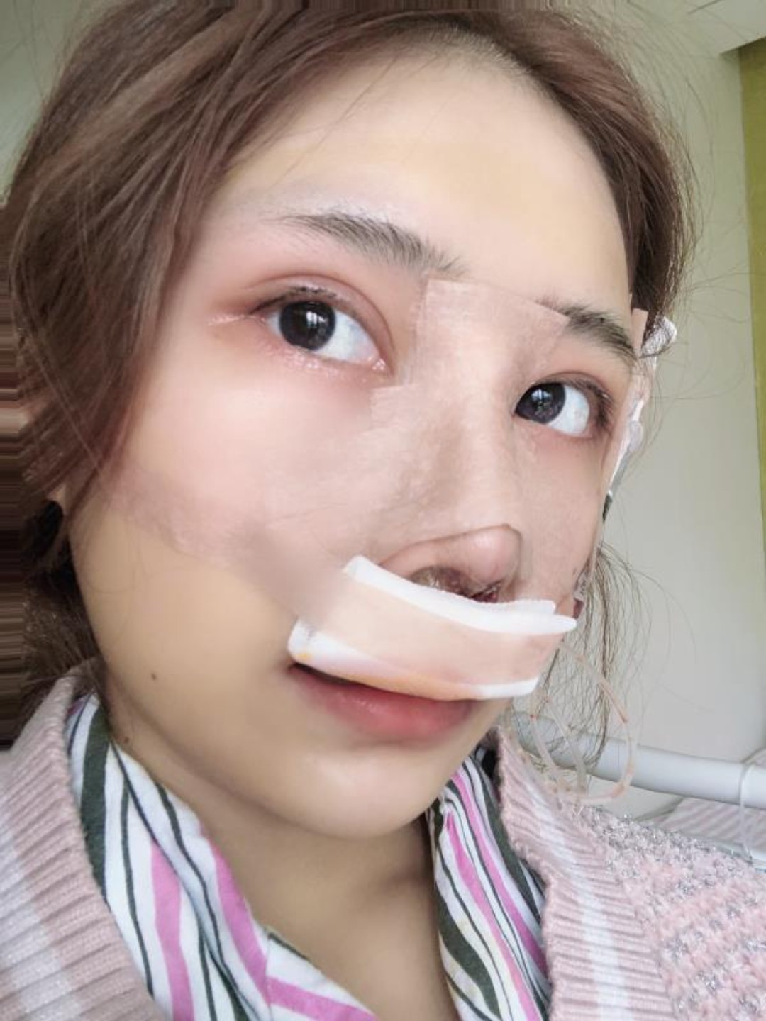 再来说说情况吧,目前还是肿得挺厉害的,可能刚刚做完手术