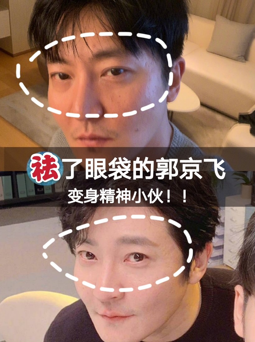 上一篇我说到郭京飞做了眶隔释放,把自己的眼袋祛除了,立马变成了精神