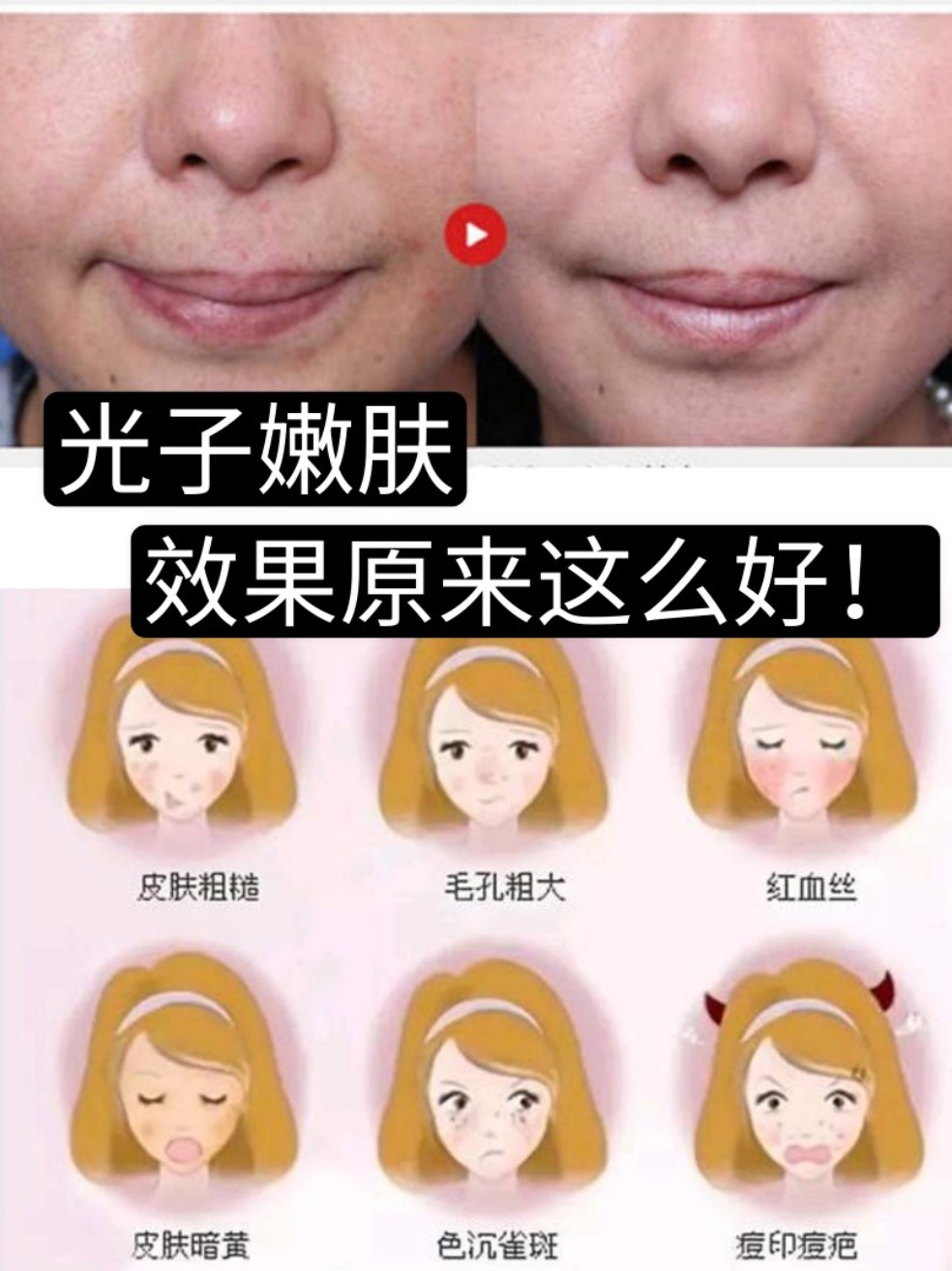 光子嫩肤是一种先进的高科技美容项目,采用特定的宽光谱彩光,直接照射