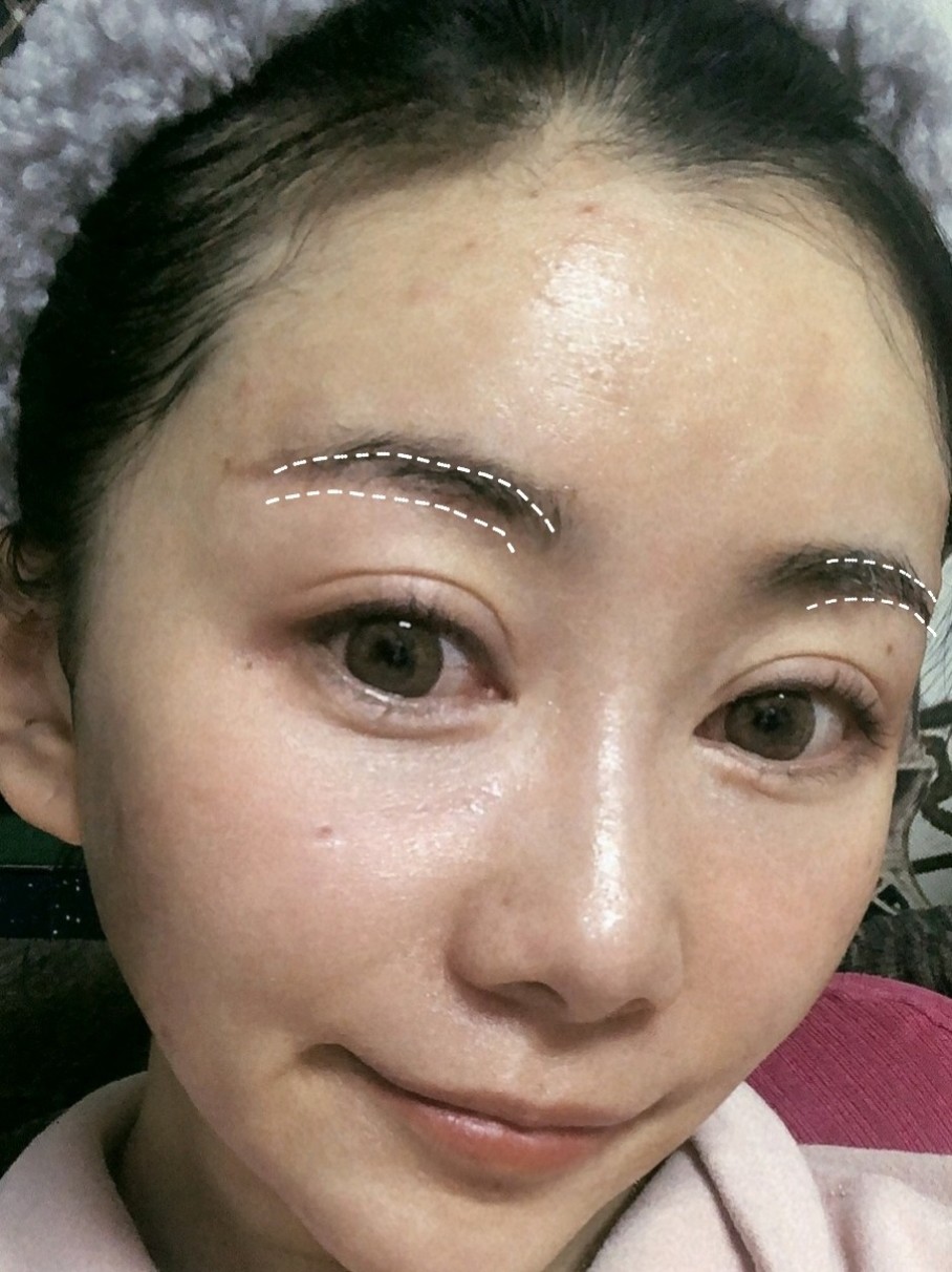 切眉术是指在眉毛周围部分进行手术,切眉术也不单单指一种手术,而是有