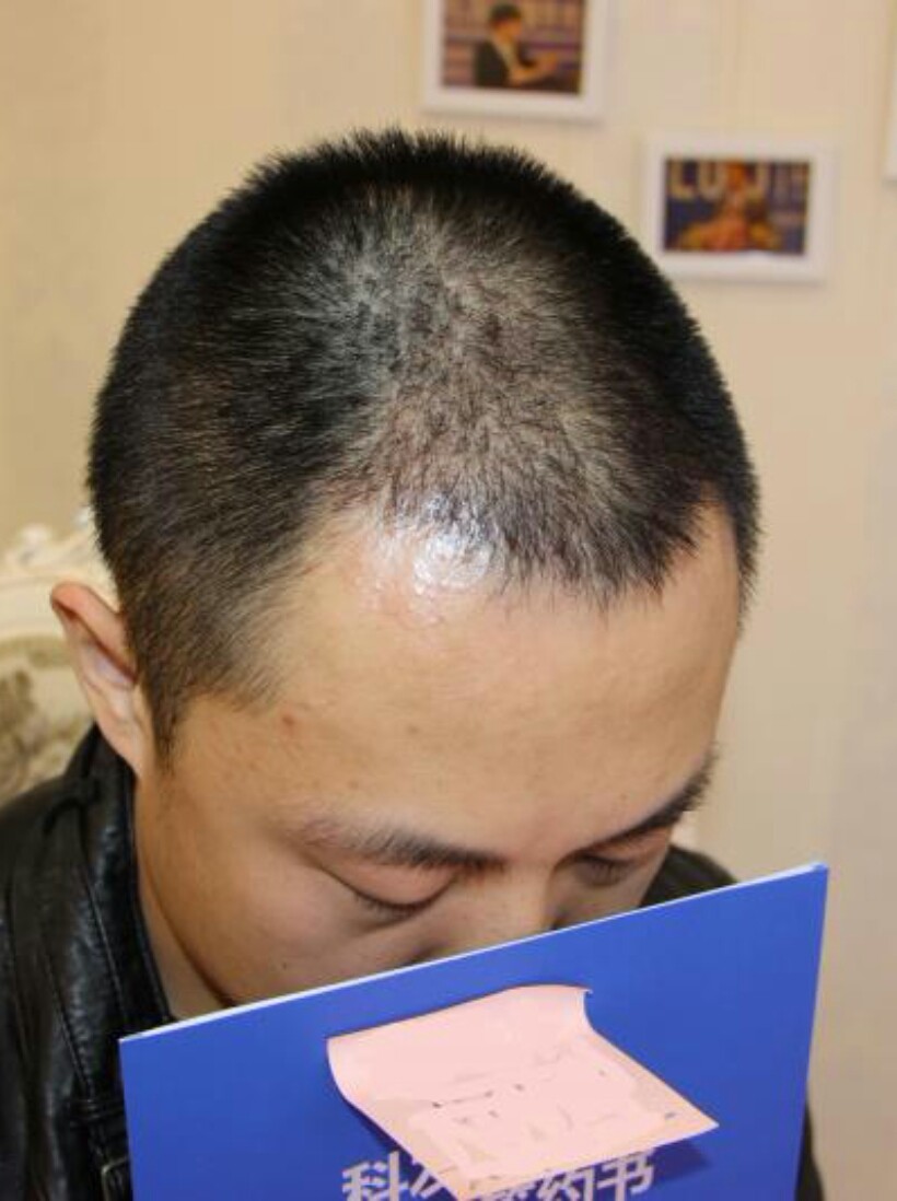 大麦微针植发术后45天:今天路过顺便去医院做了理疗_圈子-新氧美容