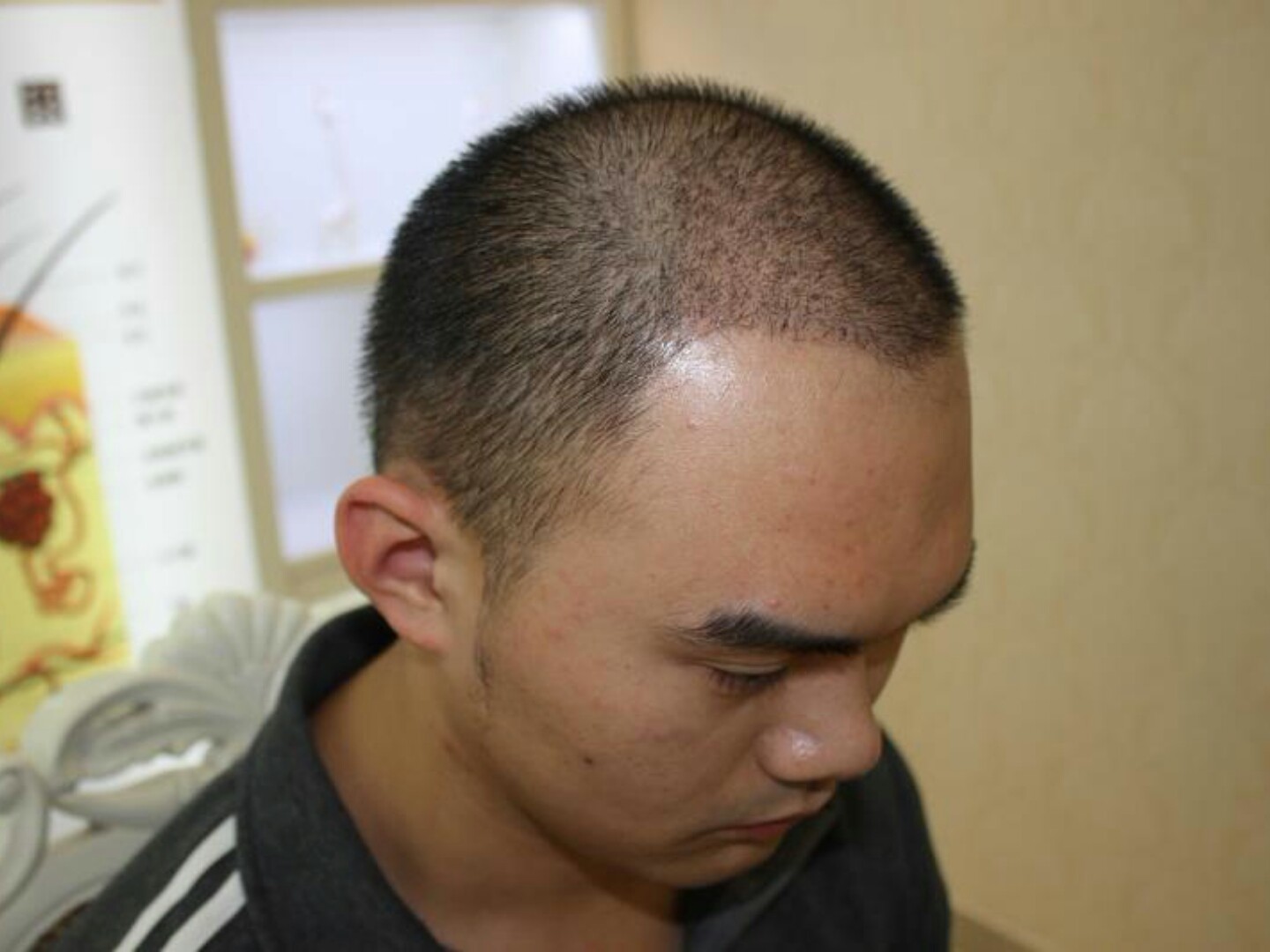 大麦植发术后20天了:跟朋友们小聚一下,他们要吃海_圈子-新氧美容整形