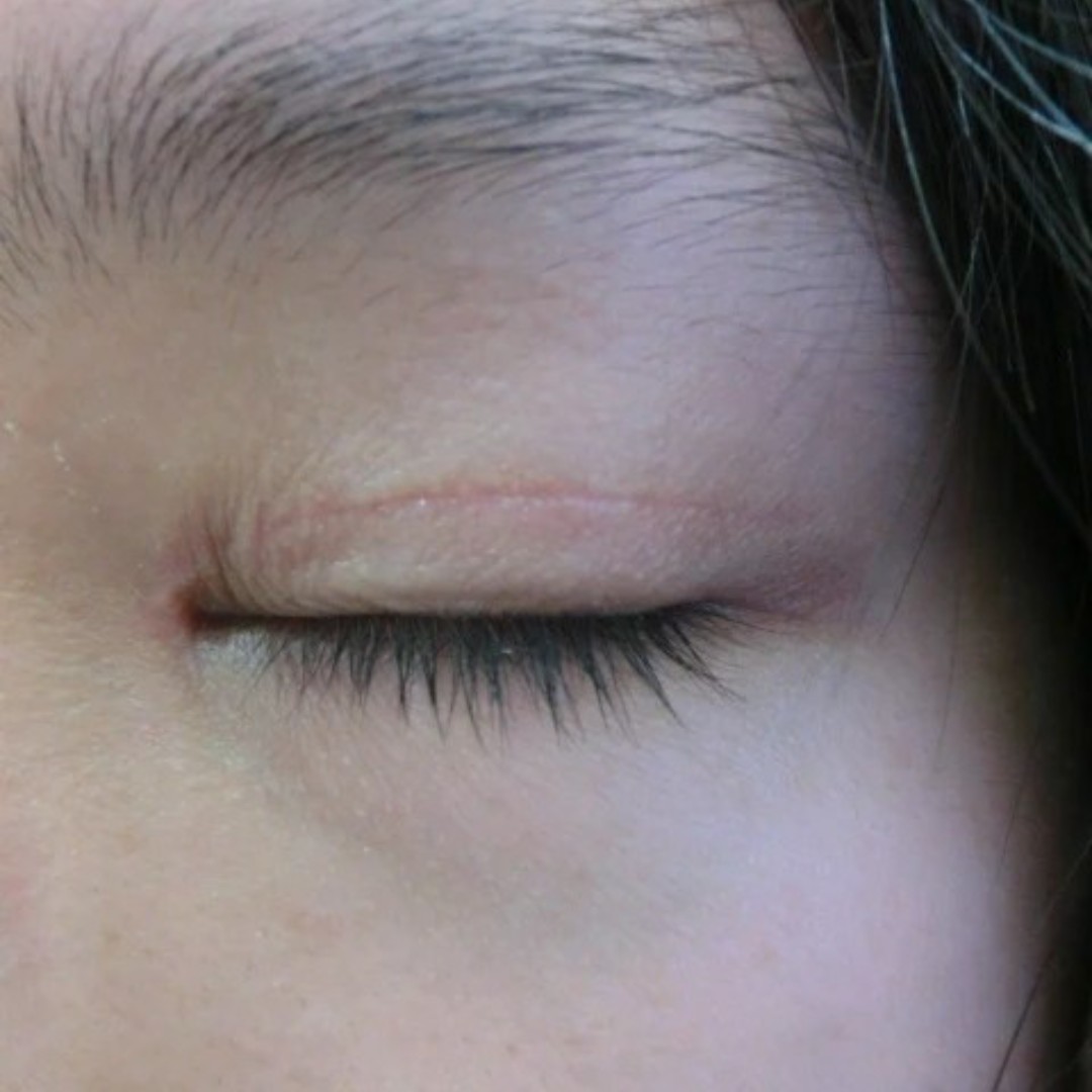 关于预防双眼皮术后疤痕增生