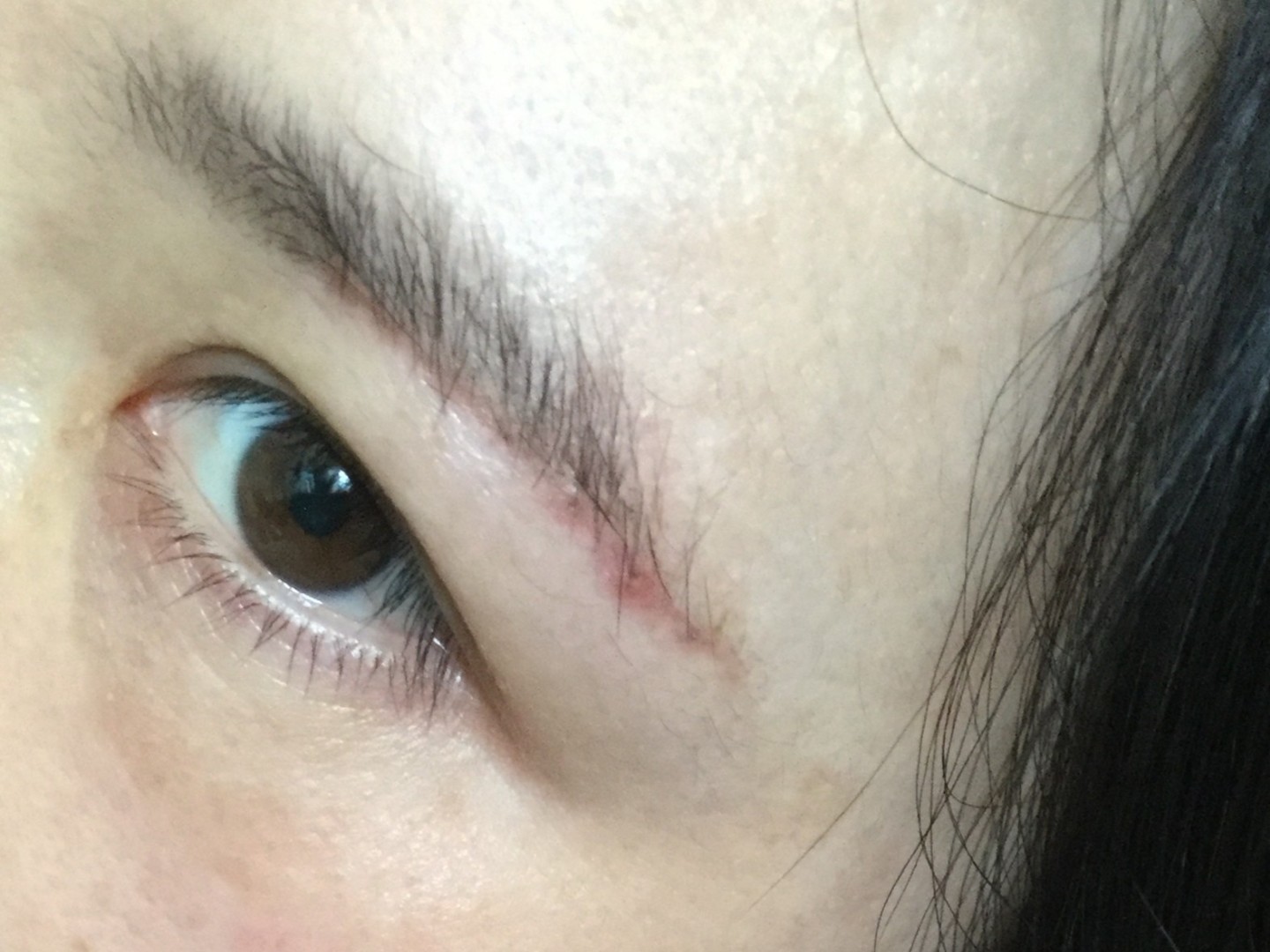 术后一个多月,才发现护士拆线时,居然4处线没拆干净_圈子-新氧美容