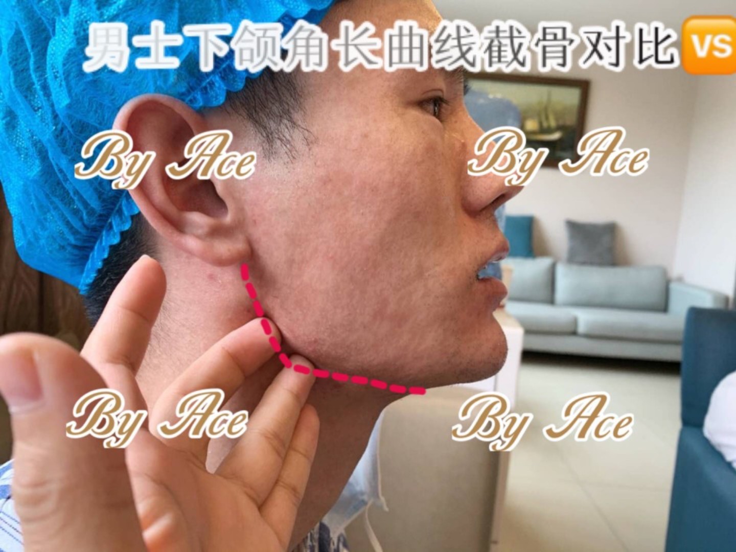 男士下颌角长曲线🇨🇭远道而来的小哥哥🔜为下颌骨肥大_圈子-新