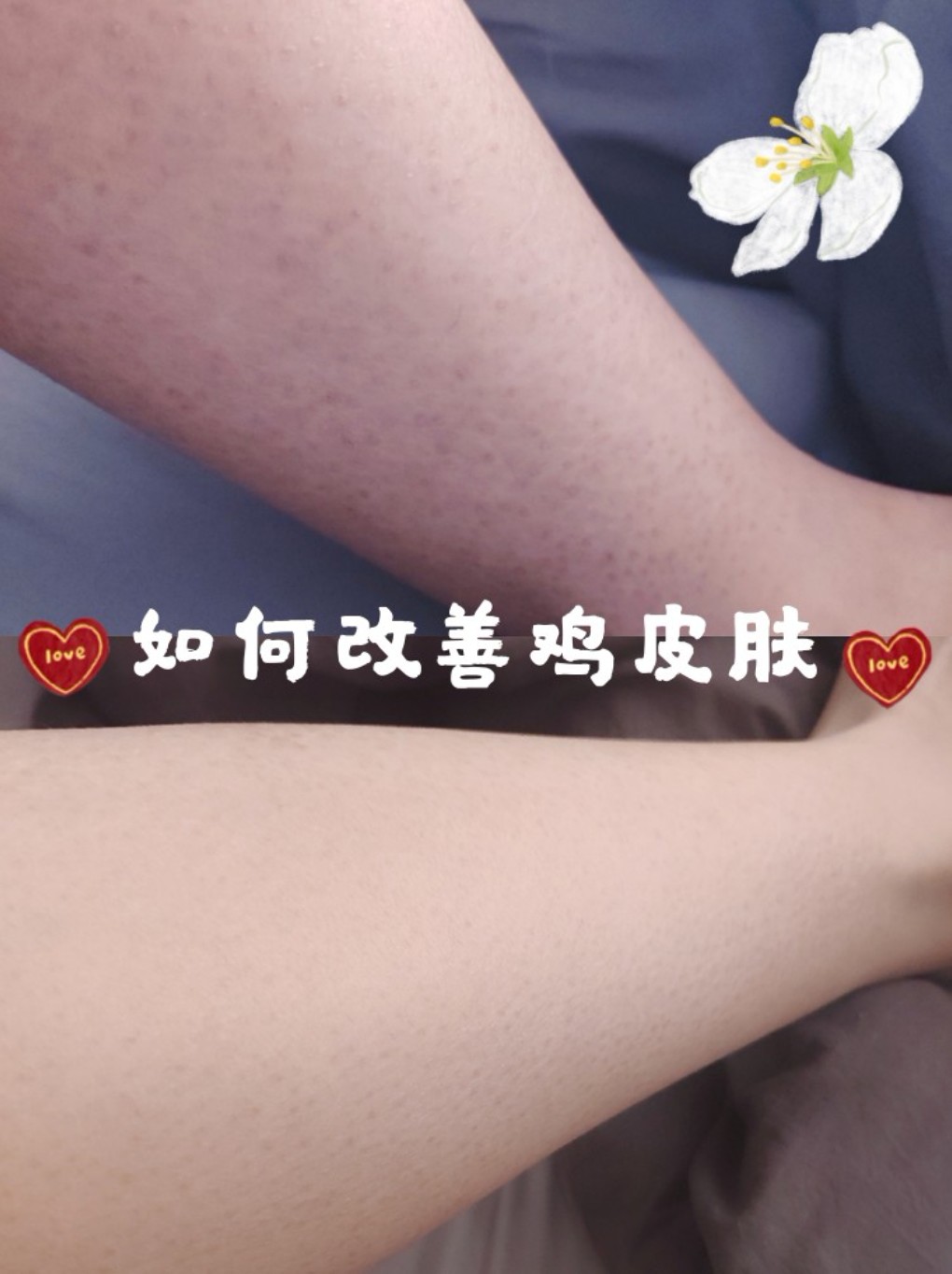 鸡皮肤鱼鳞皮肤怎么改善(鱼鳞皮肤和鸡皮肤怎么治疗)