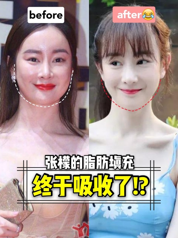 张檬的脂肪填充终于吸收了!