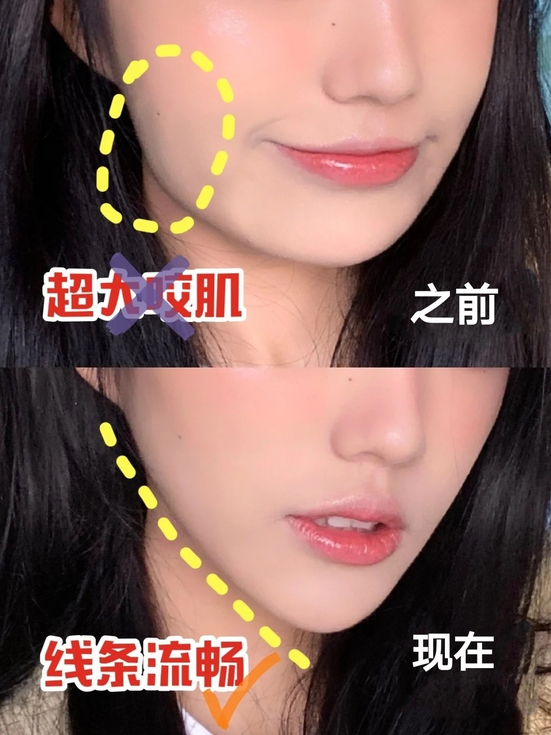 咬肌过于发达的危害: ①左右咬肌发达,导致脸型不对称 ②脸部肌肉