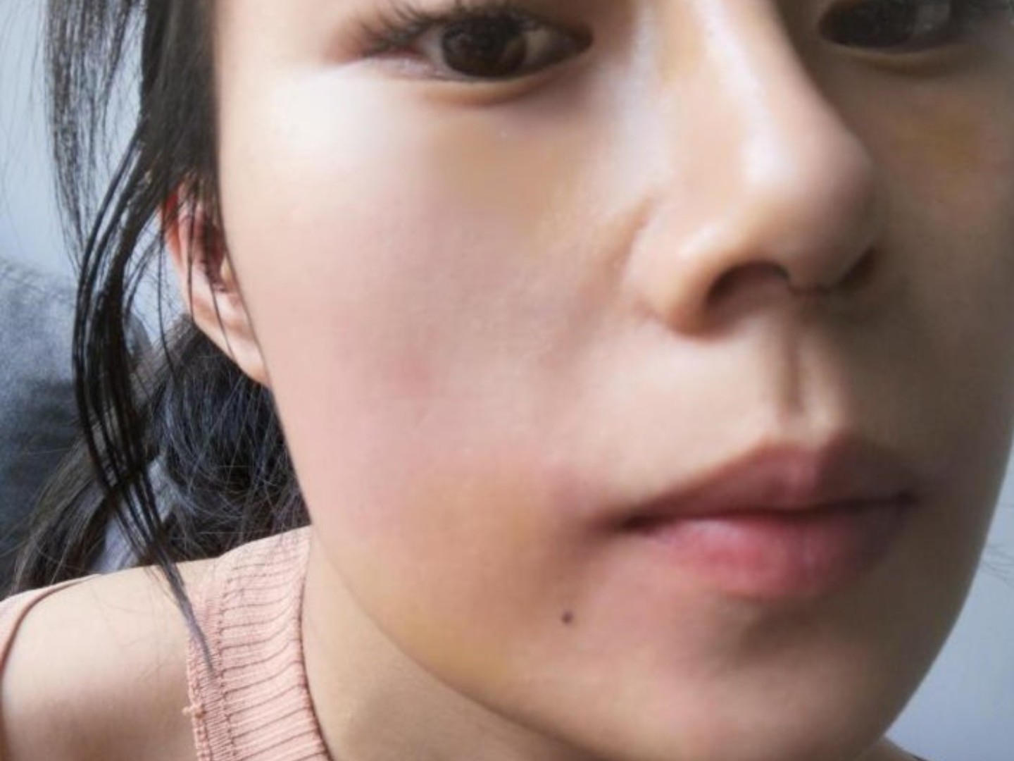 鼻子基本消肿了,鼻子轮廓已经出来了,但我还是坚持有时间热敷下,吃吃