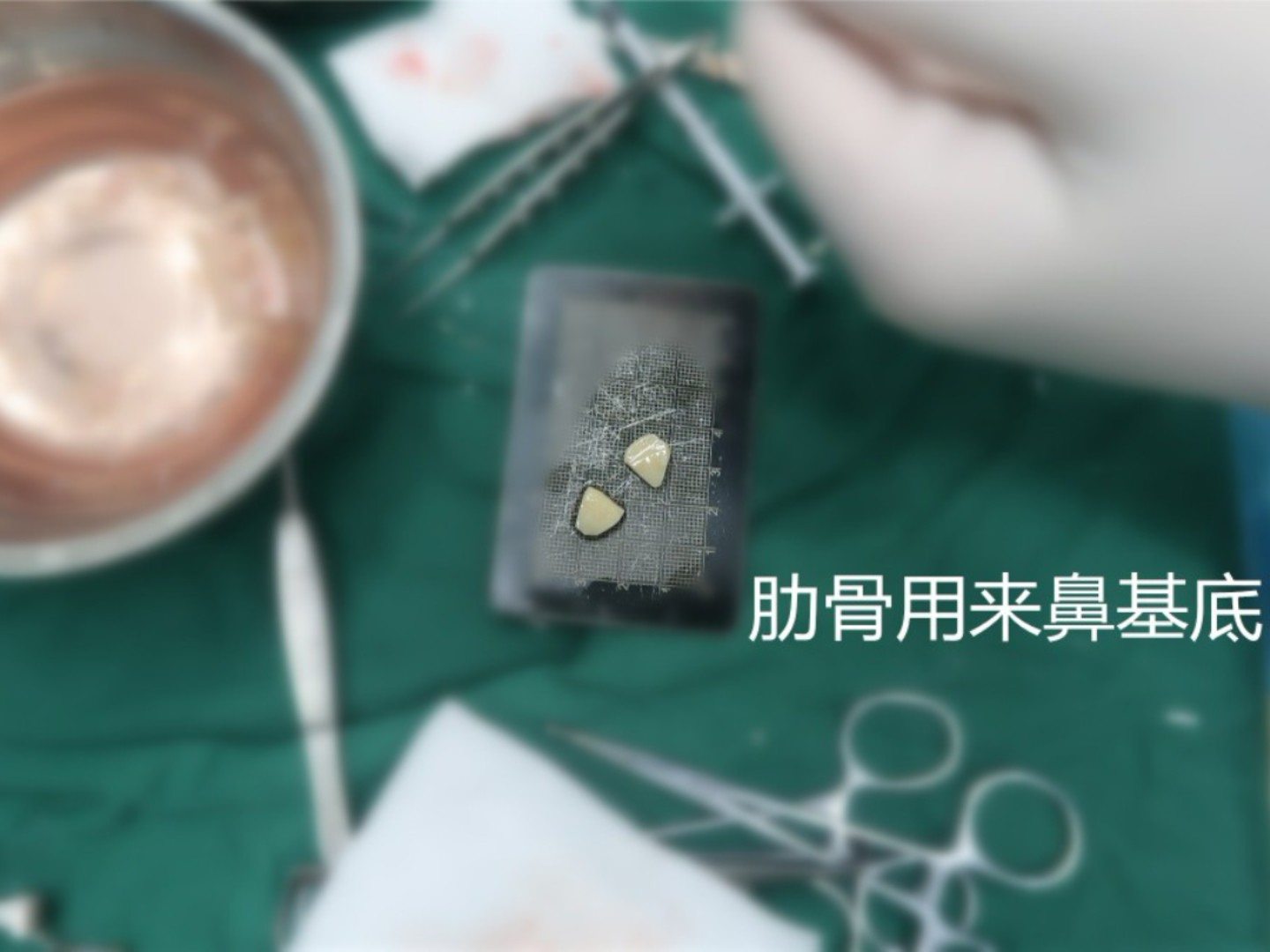 手术项目:修复肋骨鼻,肋骨垫鼻基底,鼻骨内推,收鼻翼