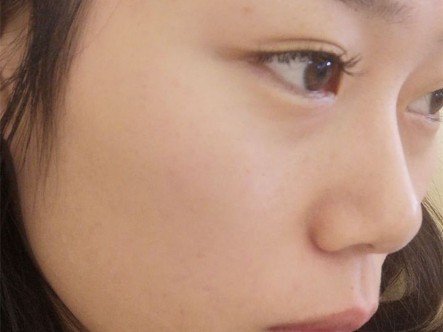 我完全是一个鼻子毁了整张脸,山根几乎没有,鼻头大鼻翼宽,鼻基底凹陷