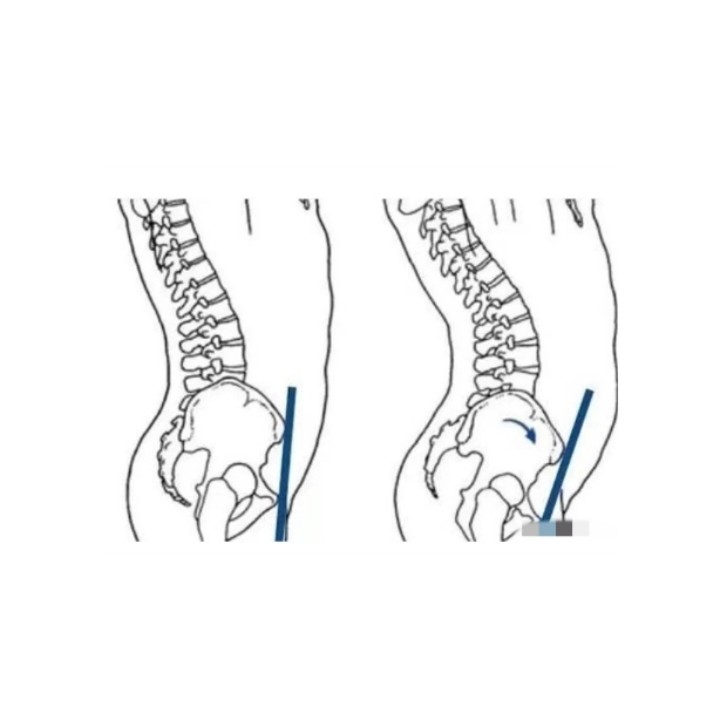 骨盆前傾導致的假翹臀假胯寬該怎麼矯正呢7878