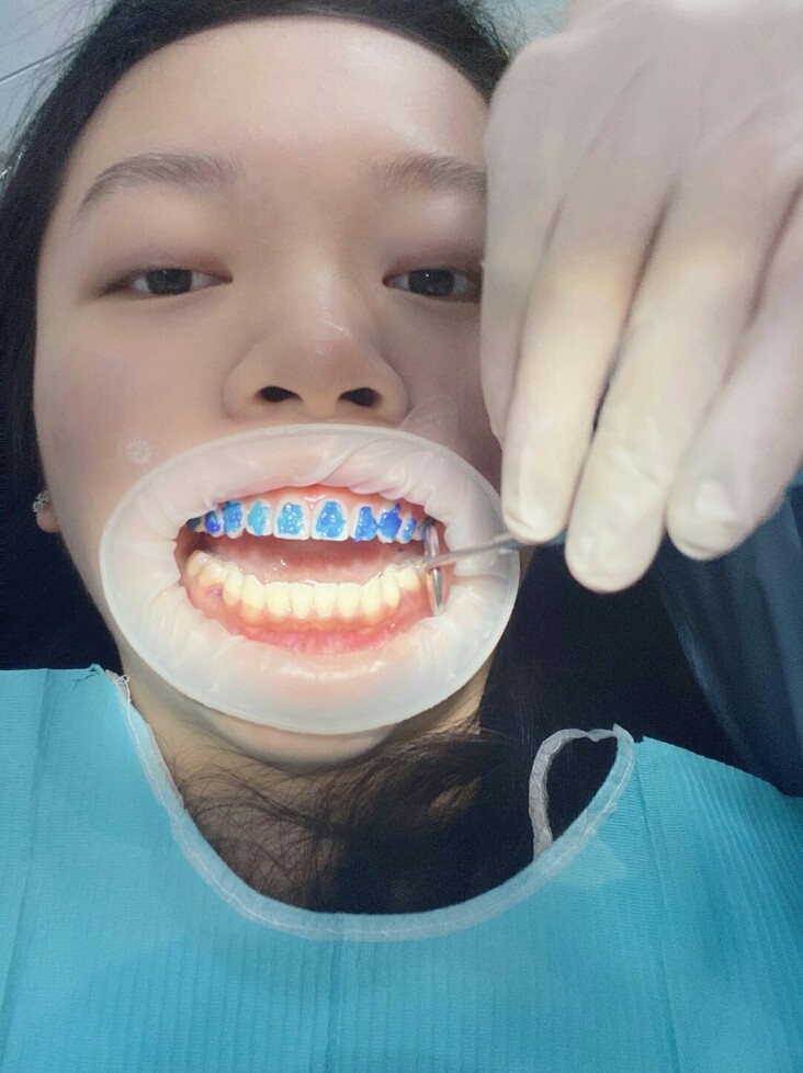 初戴牙套来说一下我的感受:首先粘托槽的过程很快,中_圈子-新氧美容