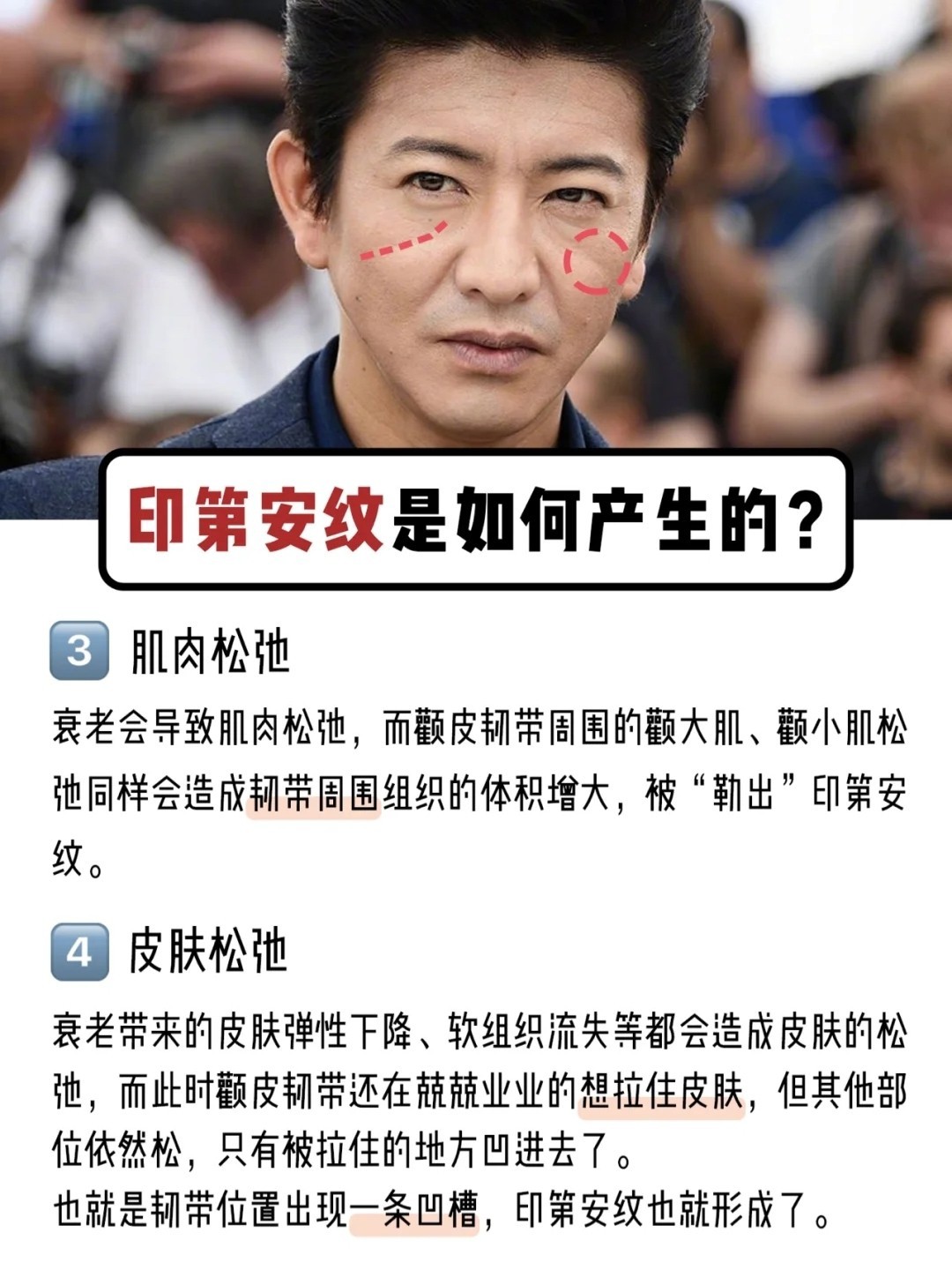 宋茜,昆凌脸上的印第安纹,最全解决方法