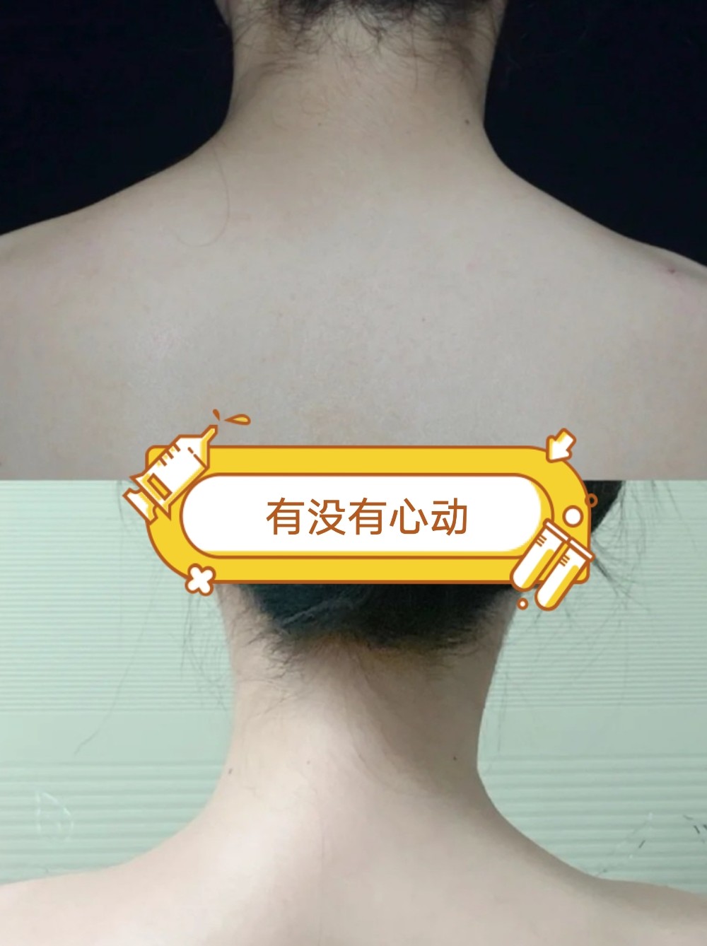 瘦肩针打的不是针而是气质 圈子 新氧美容整形 瘦肩针打的不是针而是气质 圈子 新氧美容整形