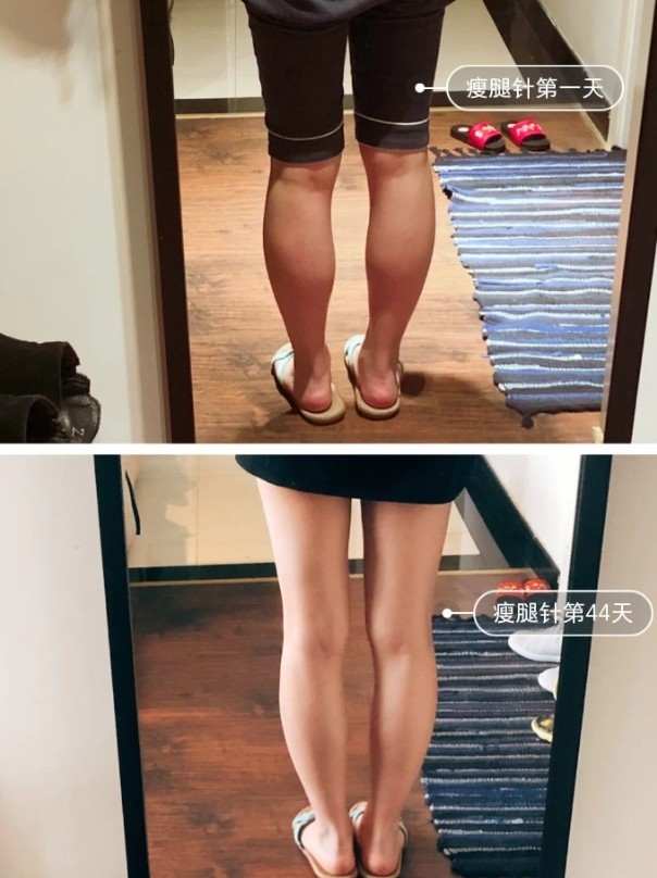 瘦腿针的作用叮铃铃夏天夏天悄悄来临,又到了各位