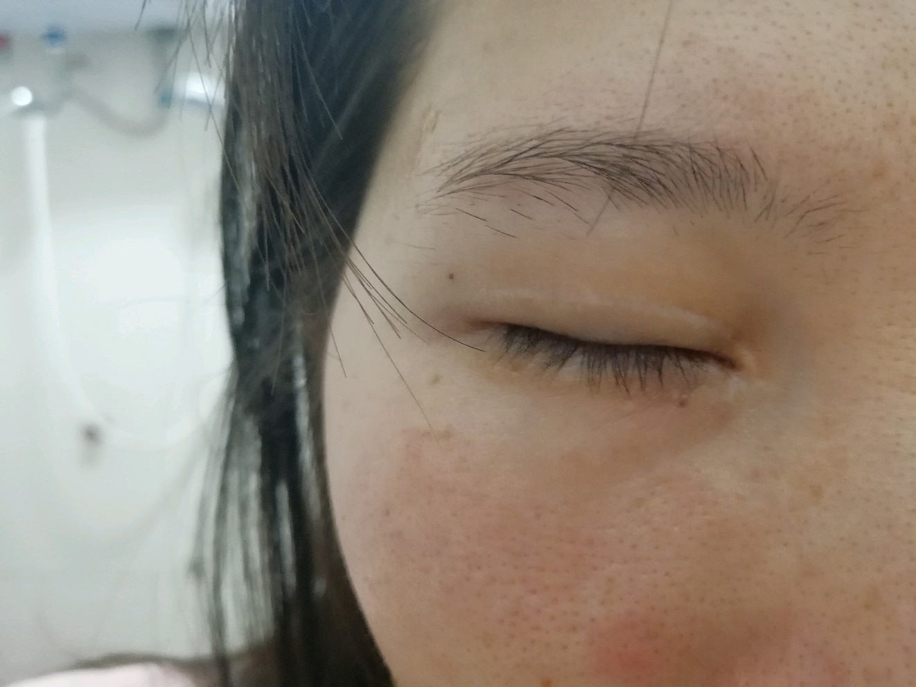 全切双眼皮加开眼角一年两个月了.